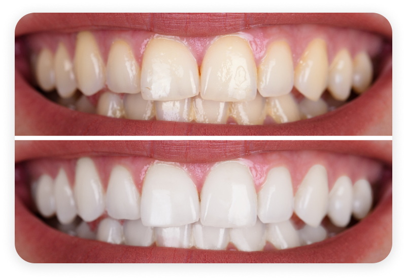 Before and after whitenting teeth
